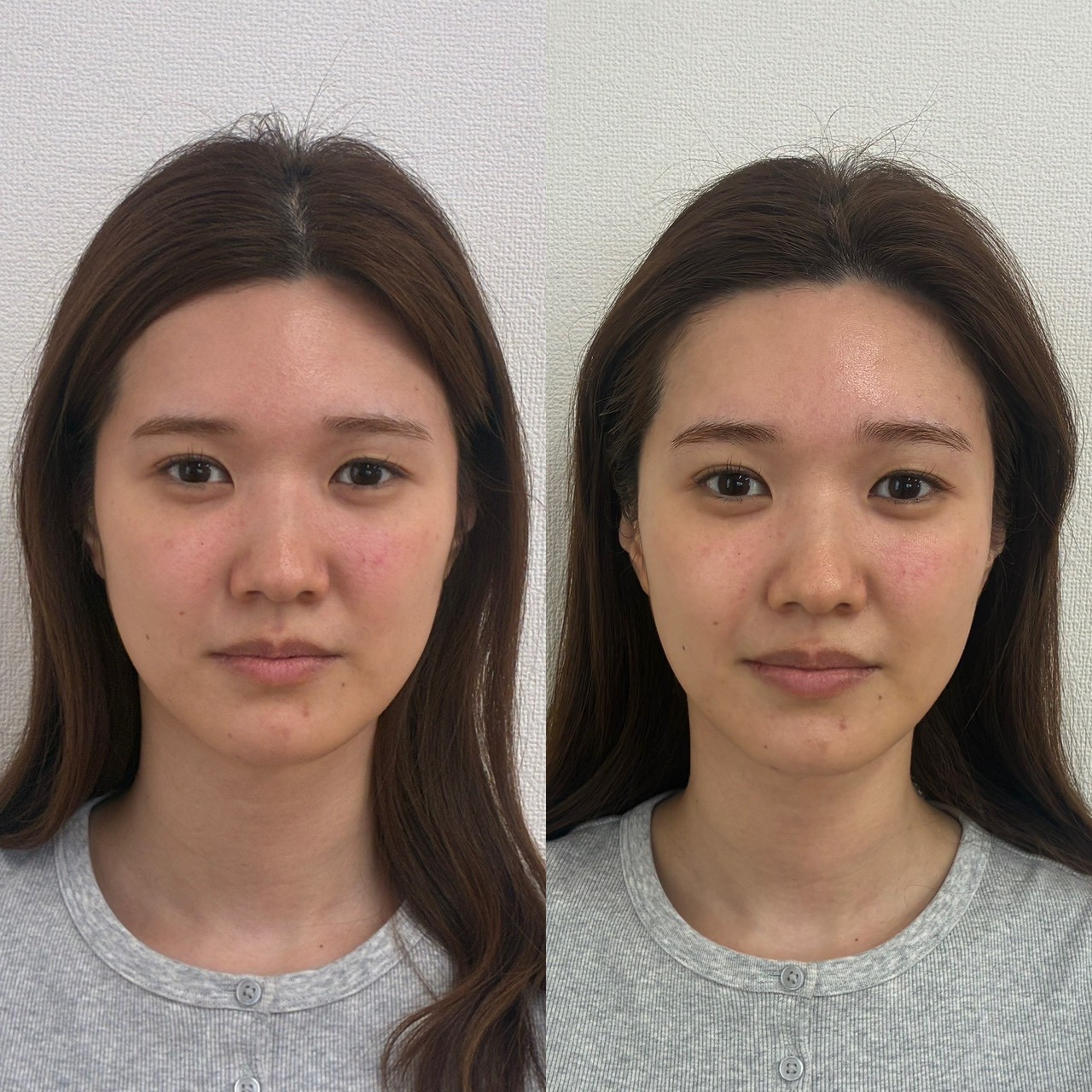 再生美容フェイシャル ビフォーアフター1