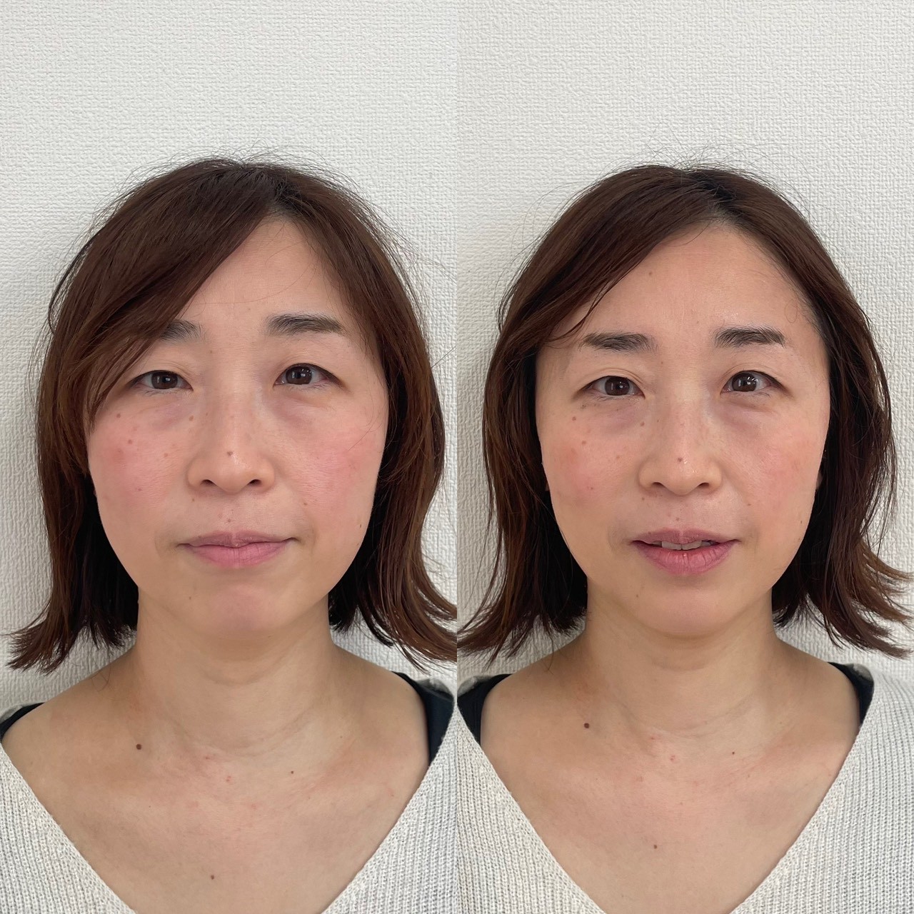 再生美容フェイシャル ビフォーアフター2